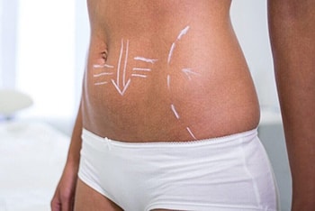 CoolSculpting vs Liposuction 