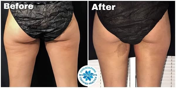 CoolSculpting-Foot thighs